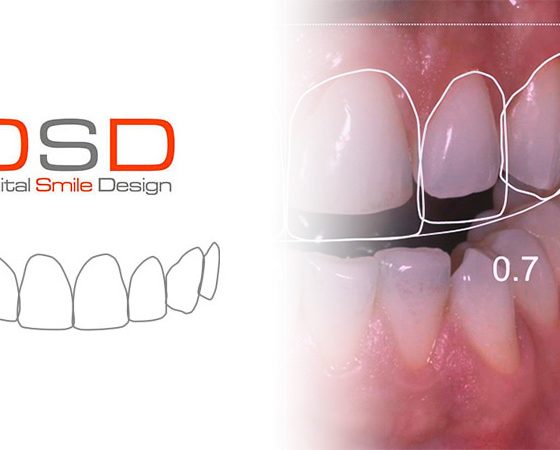 Odontología Estética / Diseño de Sonrisas