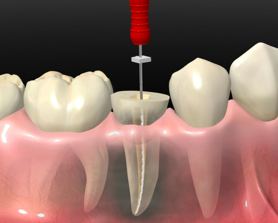 Endodoncia