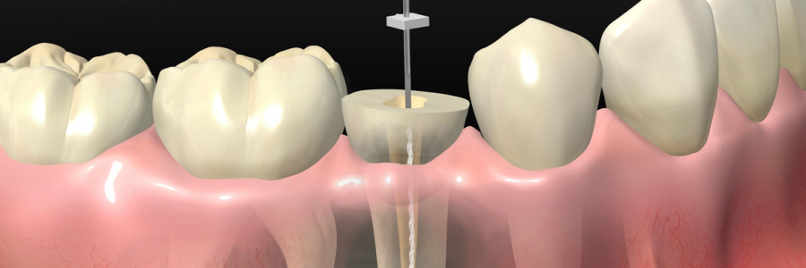 Endodoncia