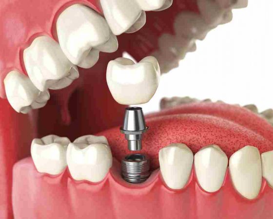 Preguntas frecuentes en implantes