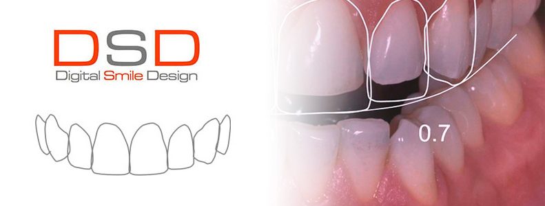 Odontología Estética / Diseño de Sonrisas